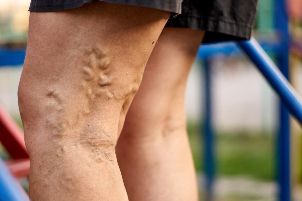 Advancing Treatment: Minimally Invasive Methods for Varicose Veins