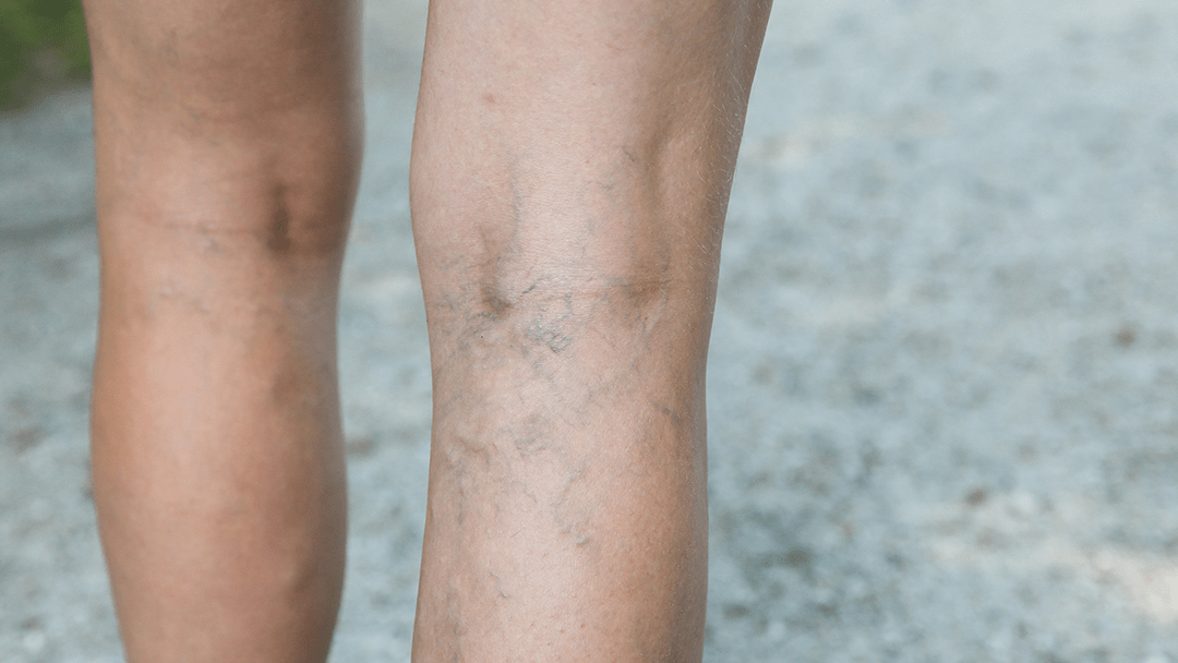 Deep Vein Thrombosis