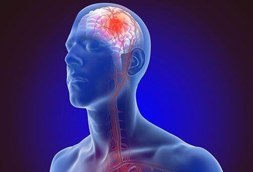 stroke image