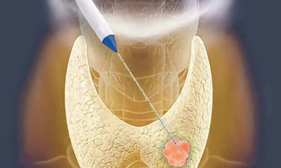 Thyroid-RFA-Procedure-Saint-Johns-Cancer-Institute
