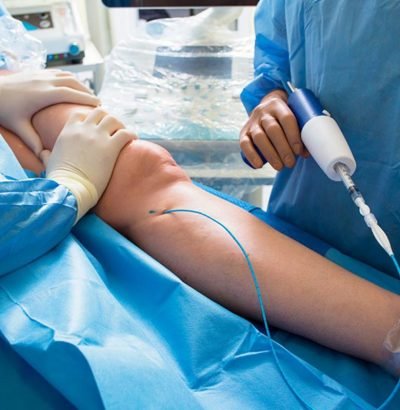 60f5d2524ede613fef9215c9_Varicose Veins Treatment FAQs About VenaSeal MAIN
