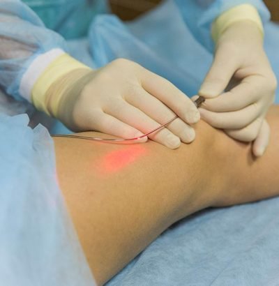 Endovenous-Laser-Treatment-EVLT