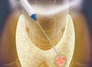 Thyroid-RFA-Procedure-Saint-Johns-Cancer-Institute
