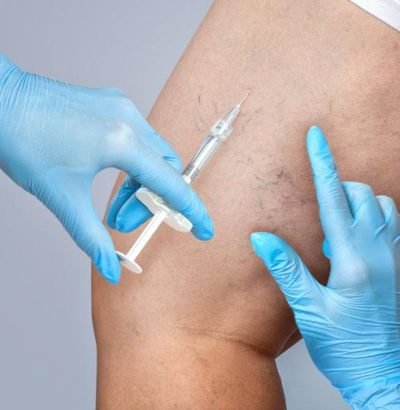 sclerotherapy (1)