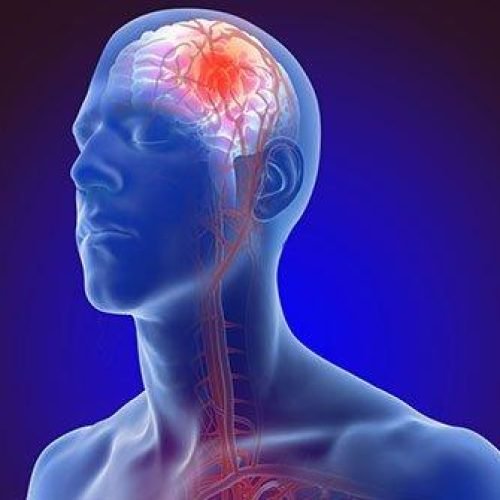 stroke image